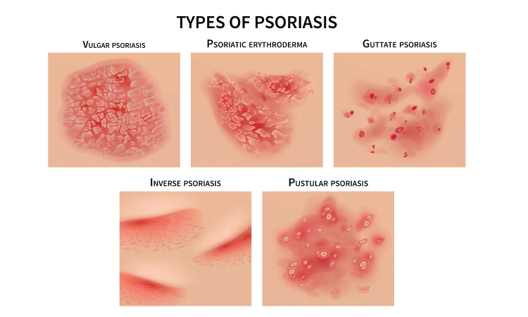 Psoriasis gets worse in summer?