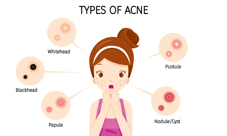 Psychological Impact of Acne