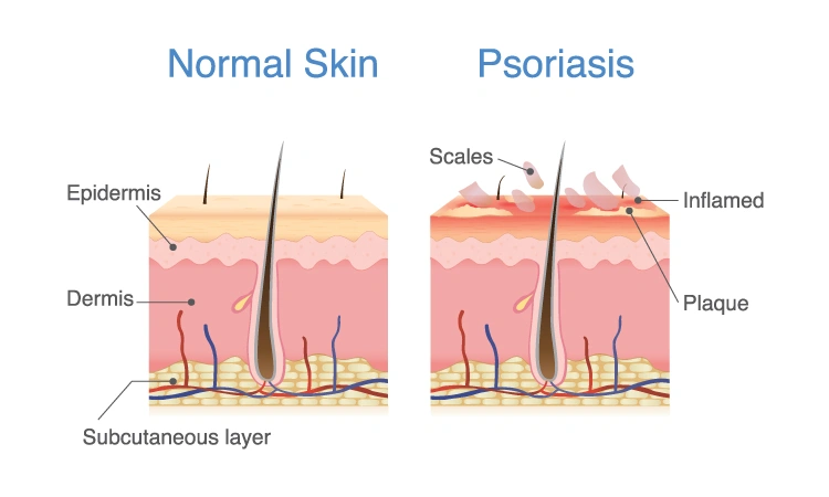 All you need to know about scalp psoriasis