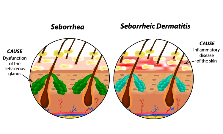 : Treatment options for Seborrhoeic Dermatitis