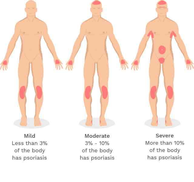 severity-of-psoriasis