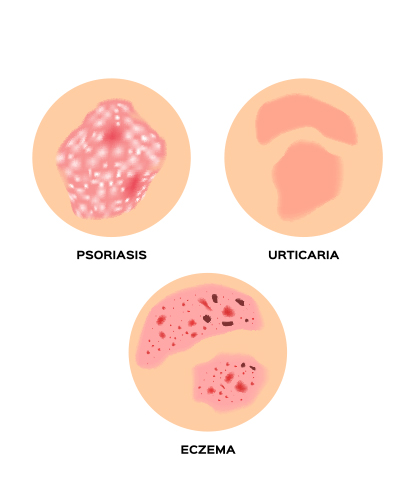 Need relief from eczema. Treat it with homeopathy!