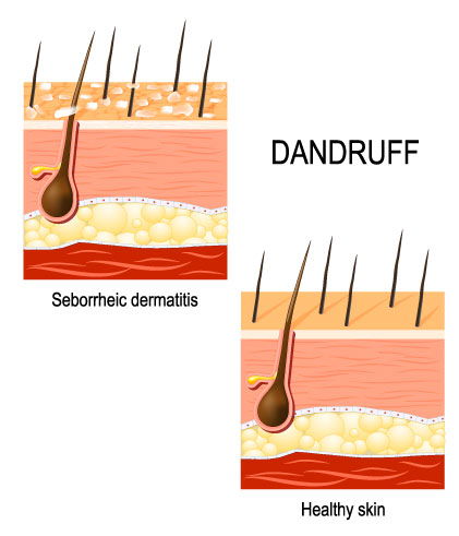 Homeopathy: Best Seborrhoeic Dermatitis Treatment
