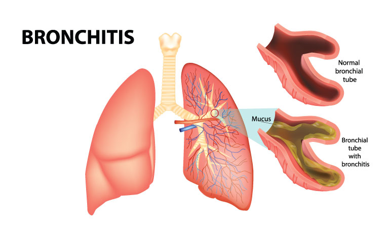Signs indicating you may have bronchitis