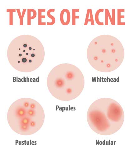 What causes acne? | Dr Batra’s™
