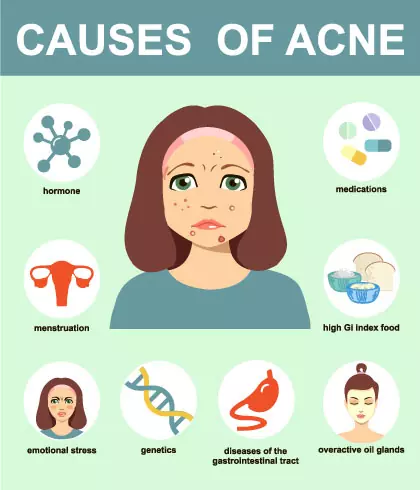 What is the best treatment for acne?
