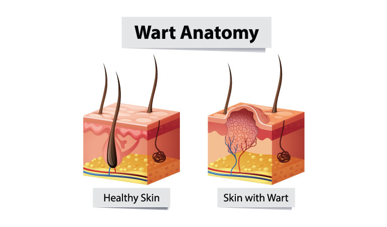 Get rid of warts with Homeopathy