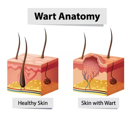 Warts: Treatment and Prevention