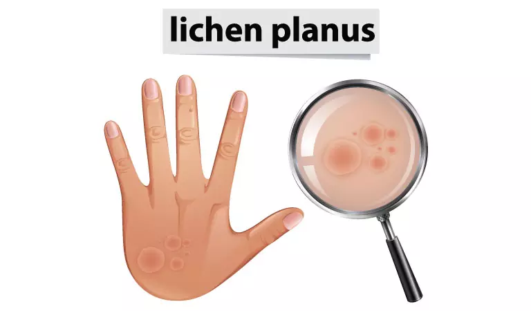 How to manage Lichen Planus?