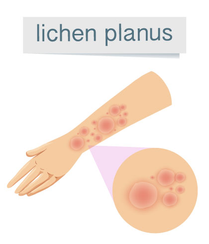 Lichen Planus Signs & Symptoms