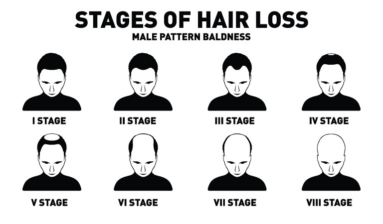 Know these stages of male pattern baldness