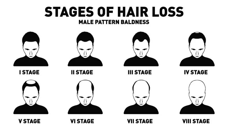 Best 15 Self-Help Tips for Male Pattern Baldness