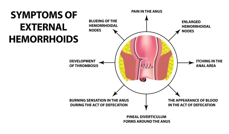 Need a cure for your embarrassing itch? Try homeopathy for piles