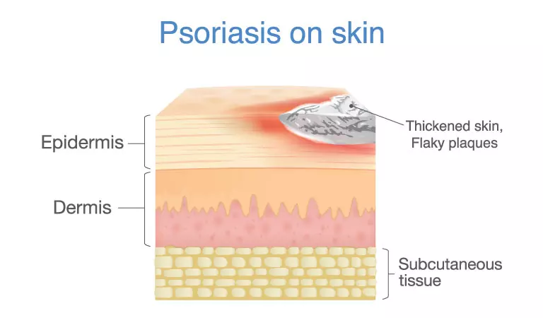 Why should you seek homeopathy treatment for psoriasis?