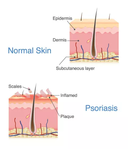 Scalp Psoriasis: Causes & Symptoms