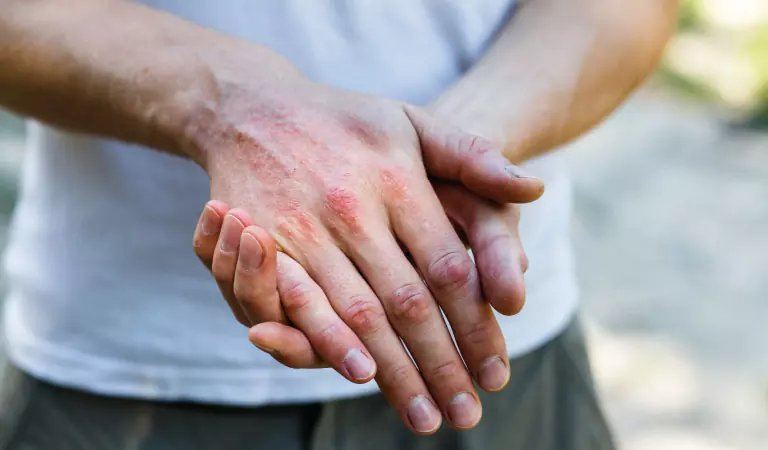 Constant hand washing harms your eczema? Homeopathy can help