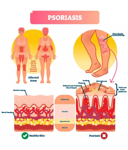 How does psoriasis affect the skin?