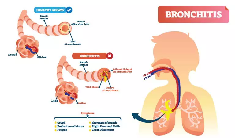 Wondering whether it is Acute or Chronic bronchitis? Homeopathy treats both