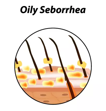 Crusty flaky scalp? It may be Seborrhoeic Dermatitis