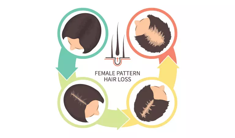 Thinning hair could indicate female pattern baldness