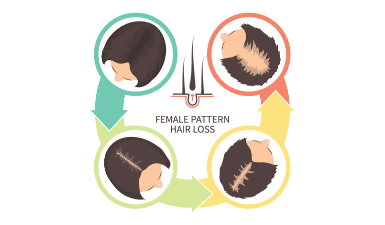 Top 5 Reasons for Female Pattern Baldness
