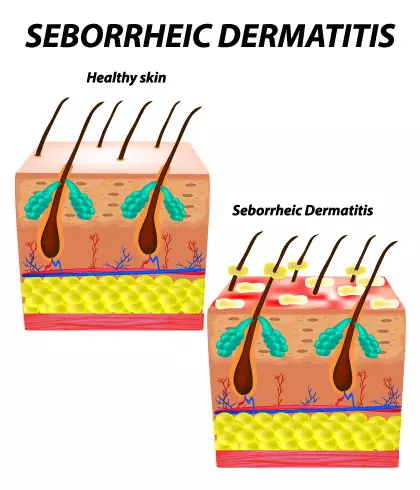Signs & Symptoms of Seborrhoeic Dermatitis