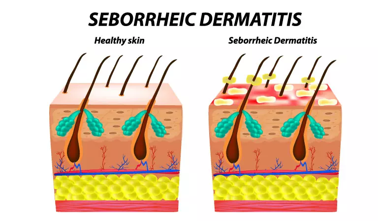All You Need To Know About Seborrhoeic Dermatitis