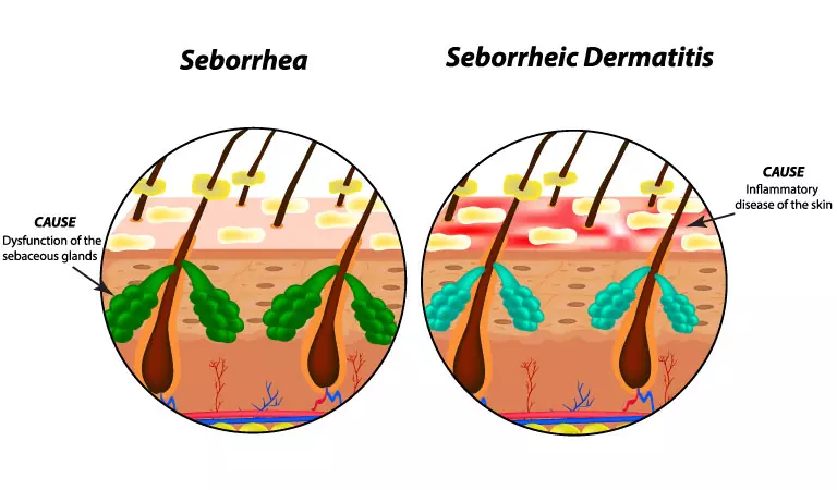 : Treatment options for Seborrhoeic Dermatitis