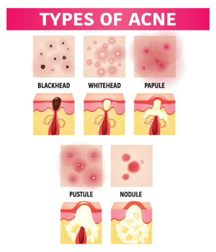 Say Goodbye to Acne with Homeopathy