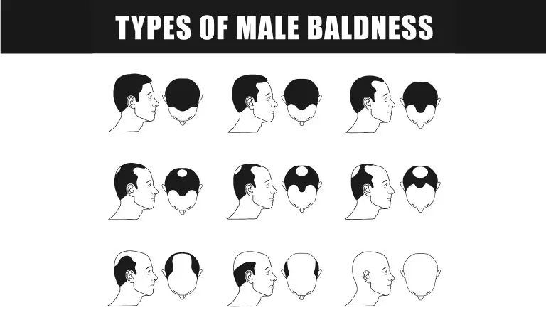 Male Pattern Hair Loss: Symptoms & Homeopathy Treatment