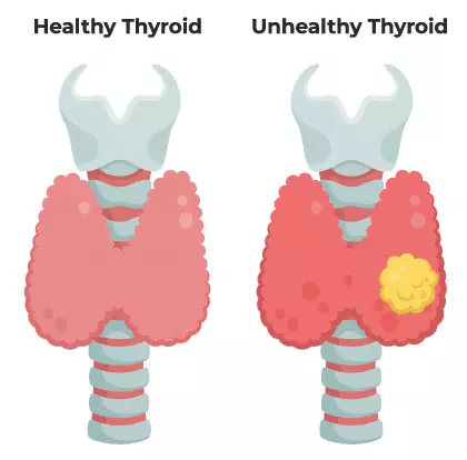 Homeopathy for Thyroid problems