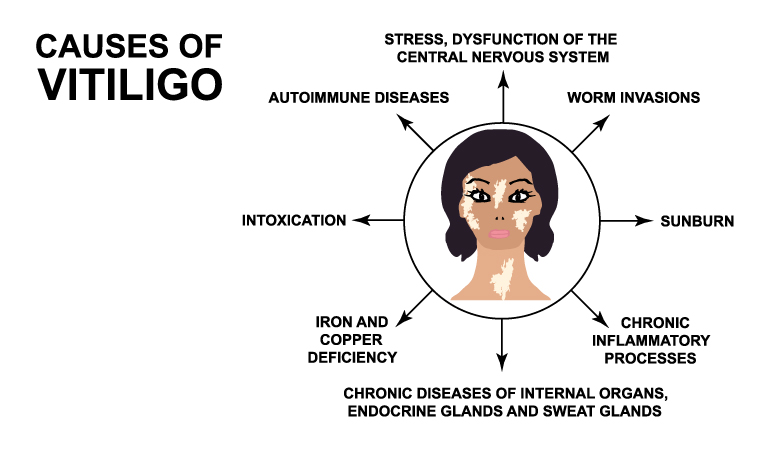 Vitiligo and Thyroid: What's the connection?