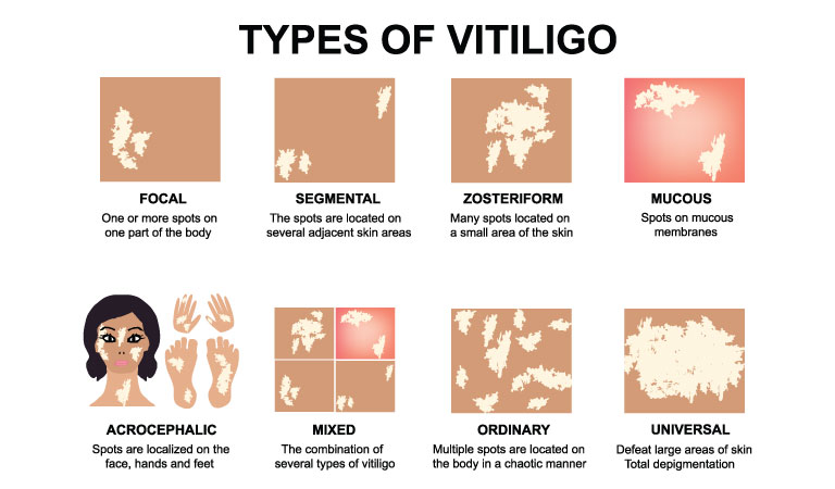 Homeopathy: Natural and holistic approach for Vitiligo
