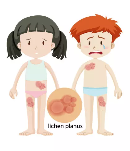 How to treat Lichen Planus?