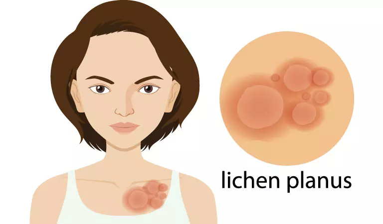 Lichen Planus - Causes & Homeopathy Treatment