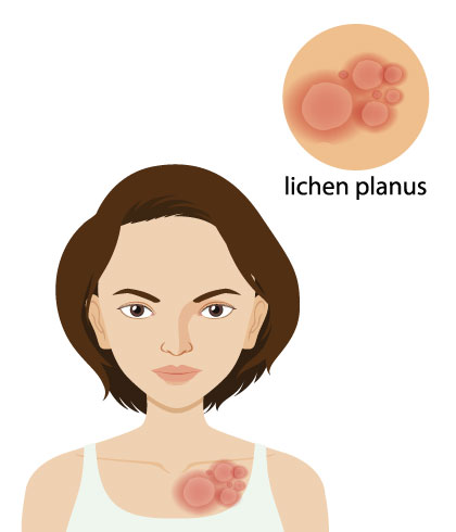 Lichen Planus Treatment