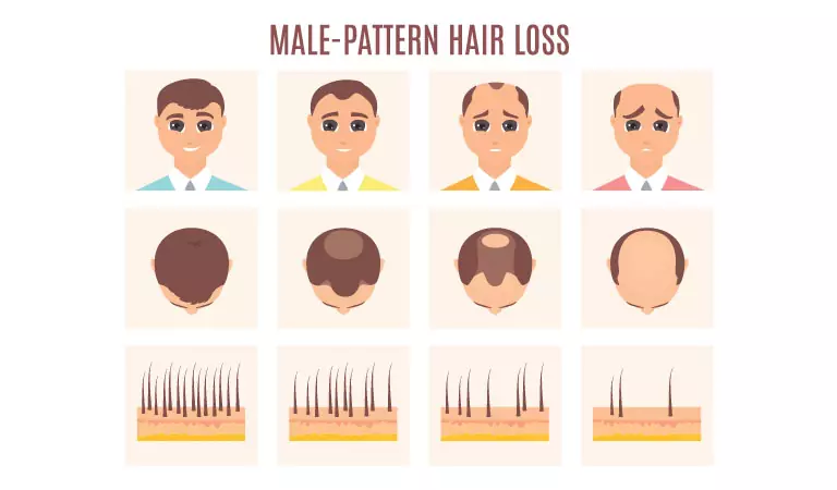 Male Pattern Baldness: Causes & Homeopathy Treatment