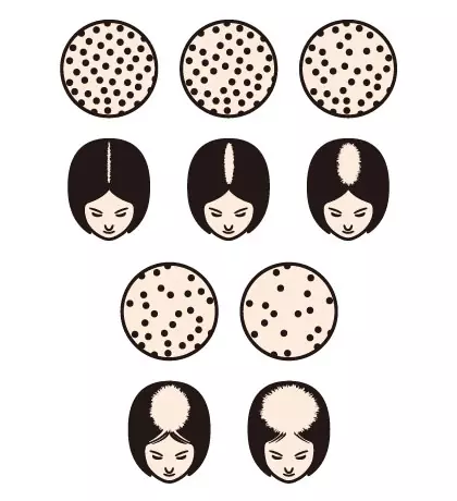 Understanding Female Pattern Baldness