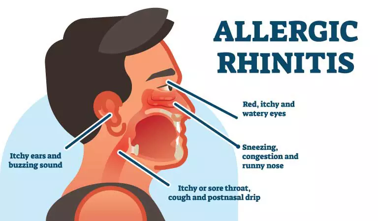 SELF-CARE TIPS TO MANAGE RHINITIS SYMPTOMS