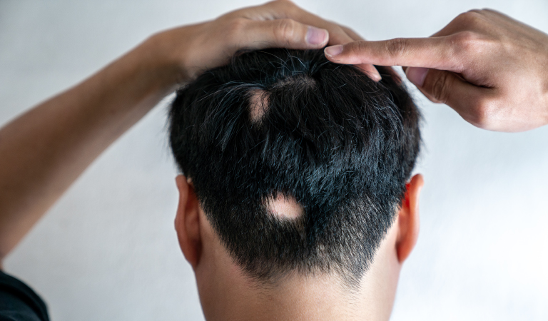Treat Alopecia Areata with Homeopathy