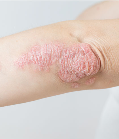 Psoriasis getting worse during winter? Try homeopathy