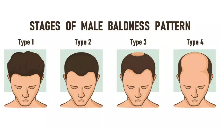 Signs and symptoms of male pattern baldness