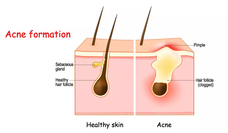 Clear Acne with Homeopathy