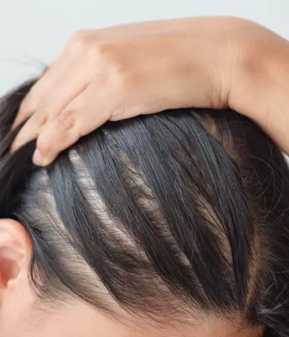 Female Hair Loss Treatment