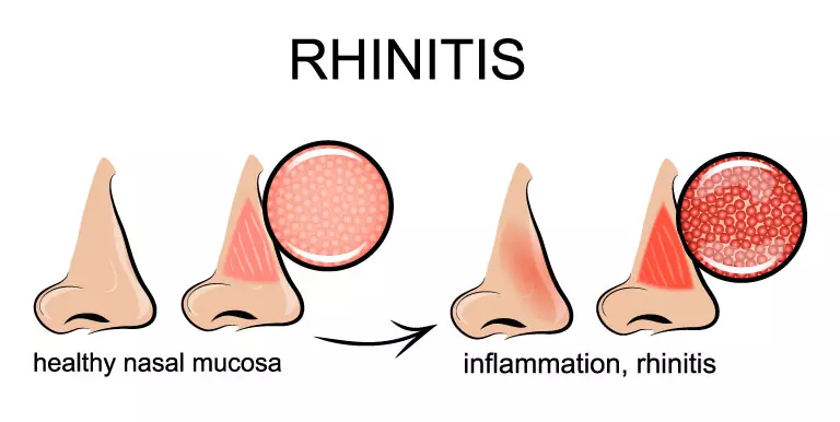 Treat your allergies with homeopathy