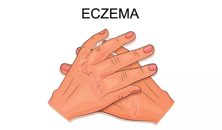 Eczema and stress: What's the connection?