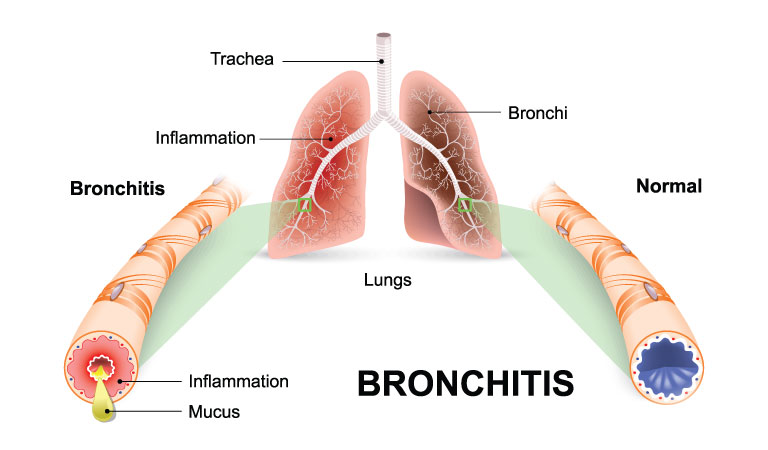 How to manage your Chronic Bronchitis?