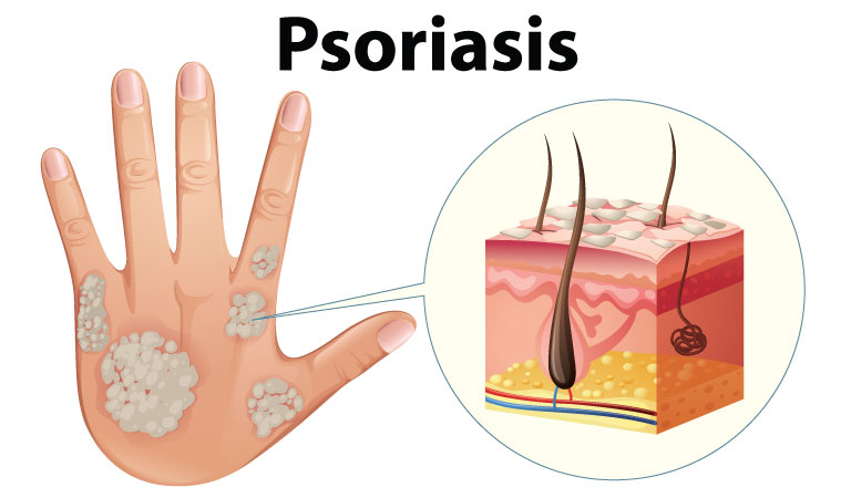 Know the 10 complications of psoriasis