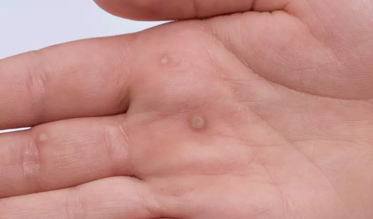 How to treat warts effectively with homeopathy?
