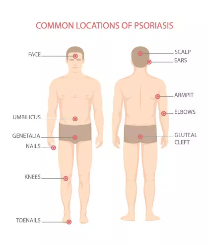 Psoriasis Triggers and Treatments